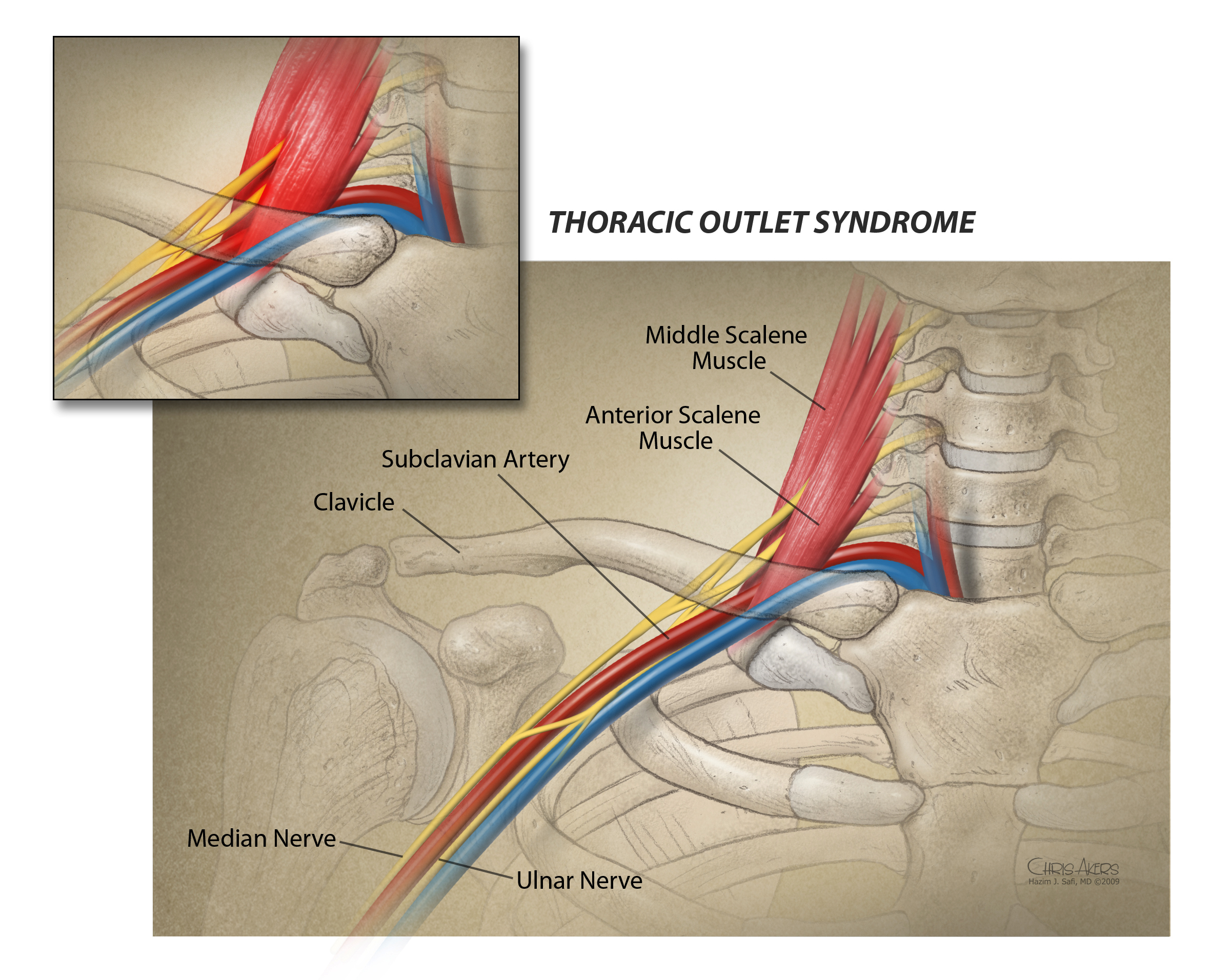 Illustration of the thoracic outlet showing the 3 common sites of