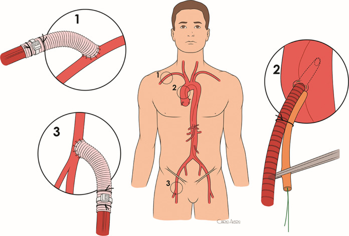 Figure 1. Cannulation sites. (1) Axillary cannulation with an 8-mm Dacron graft anastomosed to the artery in end-to-side fashion with a running 5-0 polypropylene suture. The graft is beveled in a fashion to flow more toward central rather than distally to the arm. (2) Direct ascending aortic cannulation. 