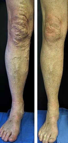 Before and After: Vein Therapy image 1
