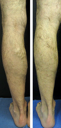 Before and After: Vein Therapy image 2