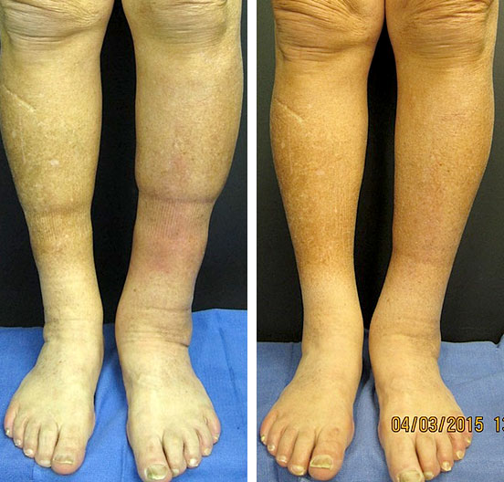 Before and After: Vein Therapy image 3