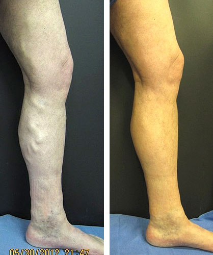 Before and After: Vein Therapy image 4