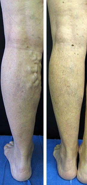 Before and After: Vein Therapy image 5
