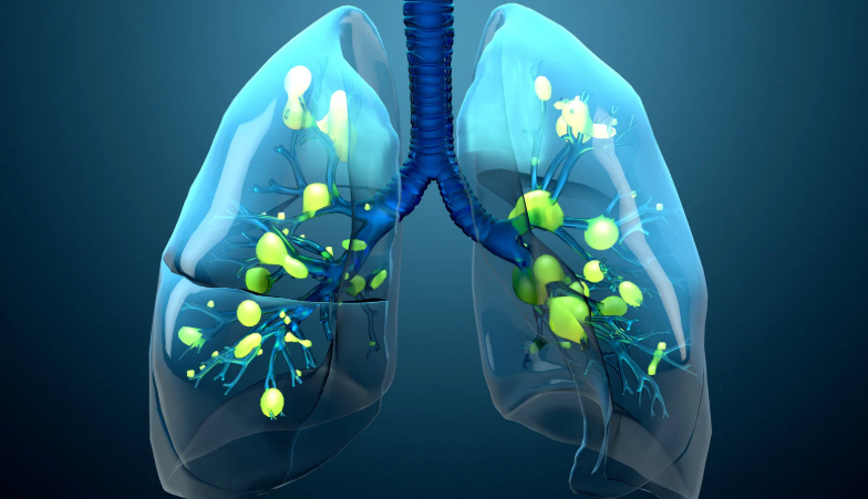 ards lung