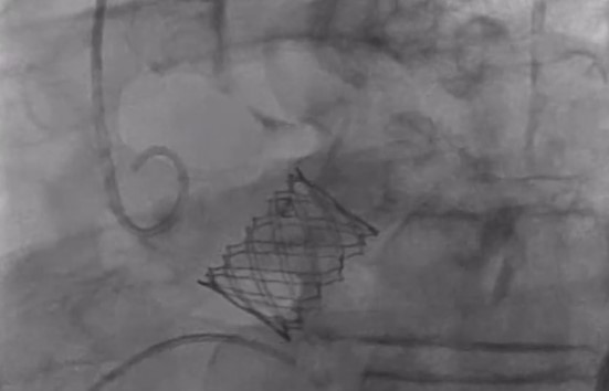 First Sapien X4 Implant in the State of Texas Performed by UTHealth Houston Heart & Vascular Physicians