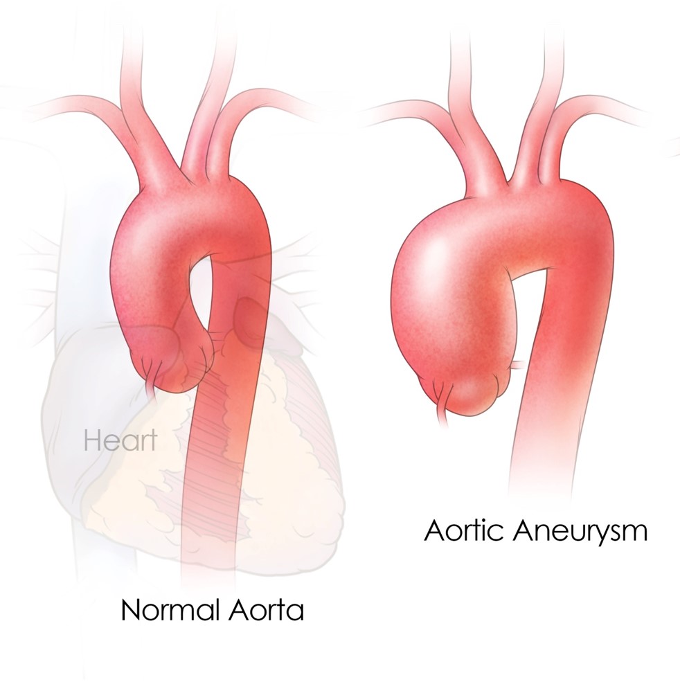 thoracic aortic aneurysm classification