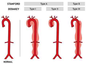 Aortic Aneurysm