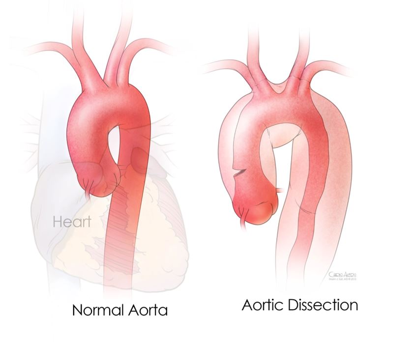 Aortic Aneurysm