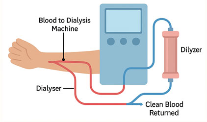 Hemodialysis