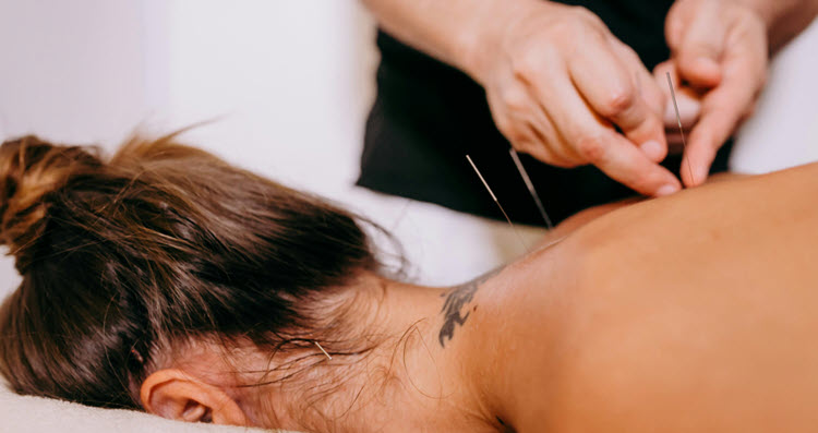 acupuncture procedure on girl with neck tattoo