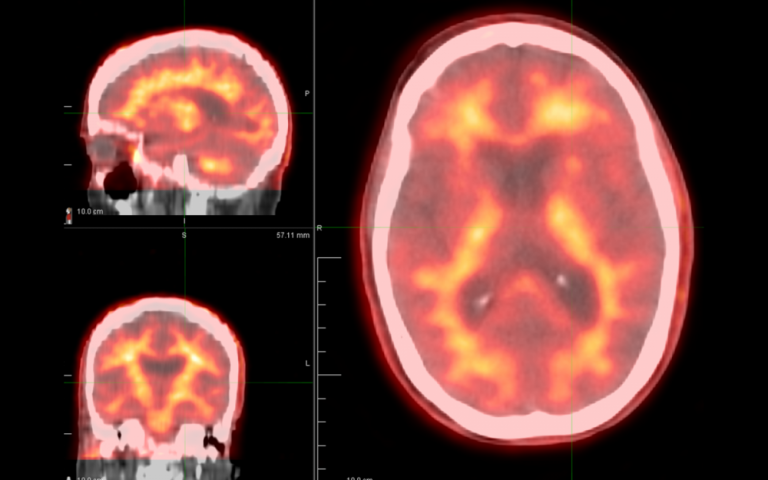 neurocognitive-disorders-mcgovern-medical-school