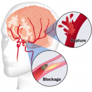 Stroke Symptoms, Prevention, and Clinics | McGovern Medical School