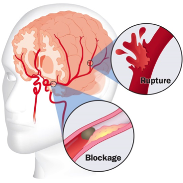 Stroke symptoms brain Stroke Symptoms