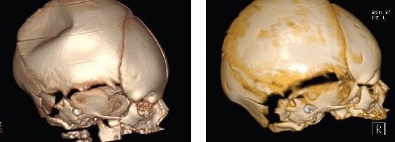 Before and after image of depressed skull