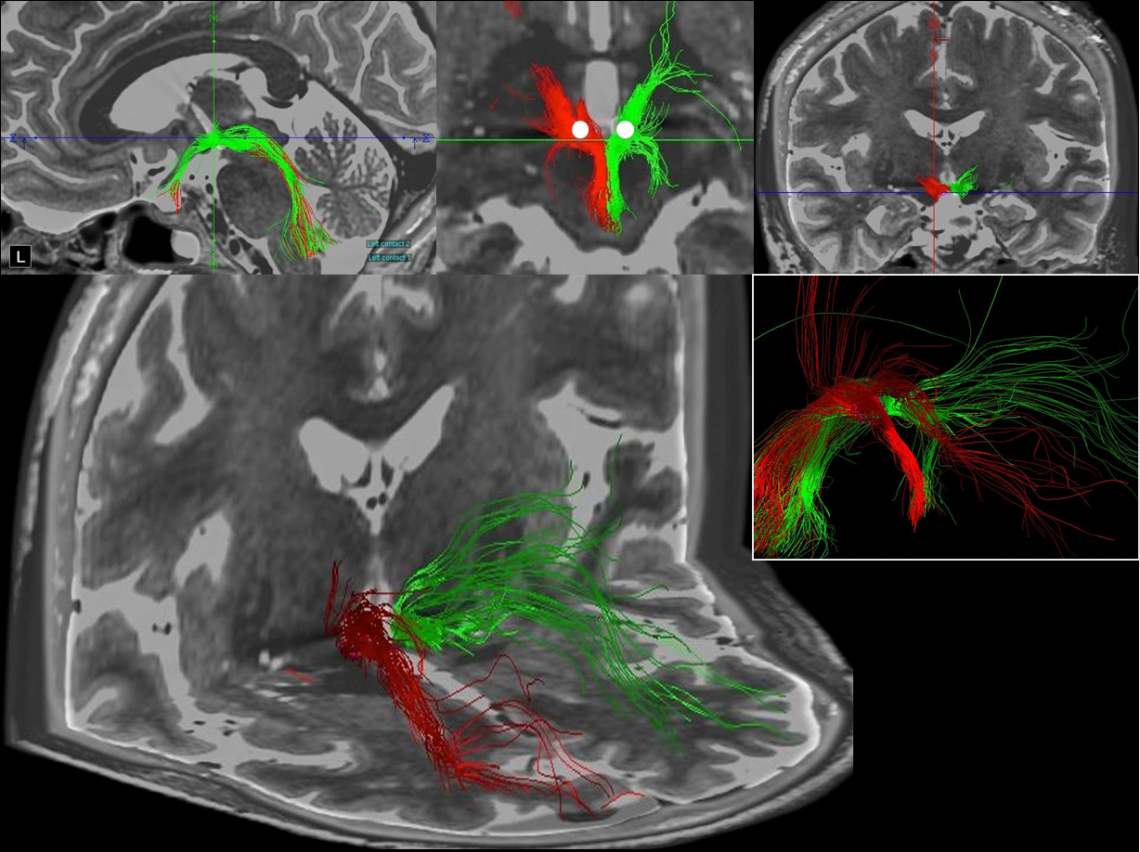 Deep Brain Stimulation Program | McGovern Medical School