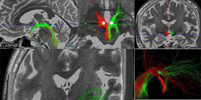 brain MRI scans
