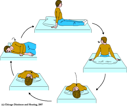 image from Home Epley Maneuver