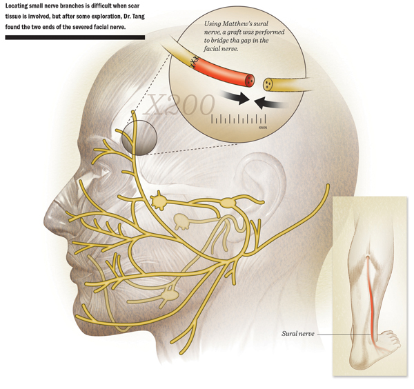 nerve graft diagram