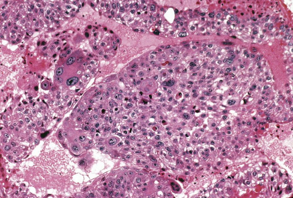 image from Using Intraoperative Staining to Identify the Parathyroid Adenoma