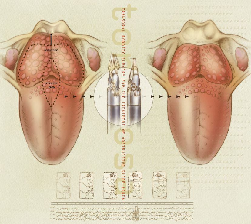 image from Transoral Robotic Surgery for the Treatment of Obstructive Sleep Apnea