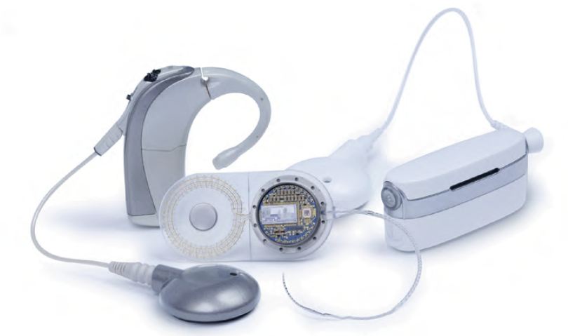 cochlear implant