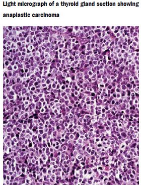 Anaplastic thyroid pathology