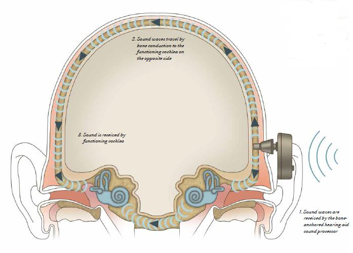 Bone-anchored hearing aids diagram