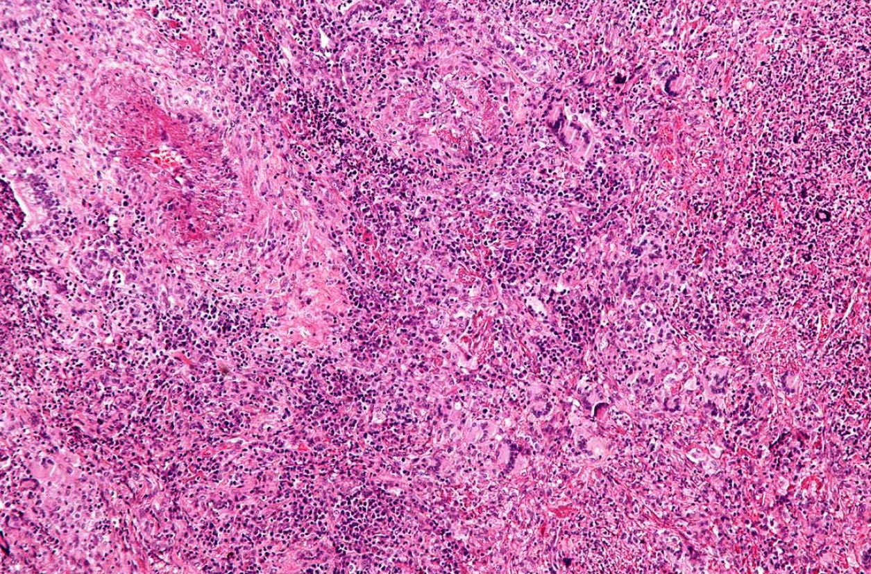 image from Granulomatosis with Polyangiitis: A Patient Benefits from Multidisciplinary Care