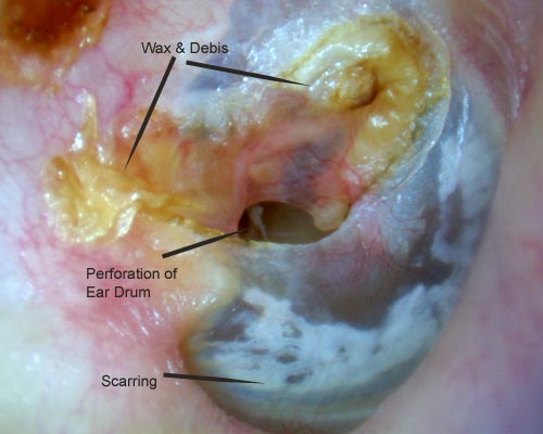 ear drum has a hole in the posterior, superior portion of the drum