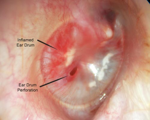 Right ear with a small perforation