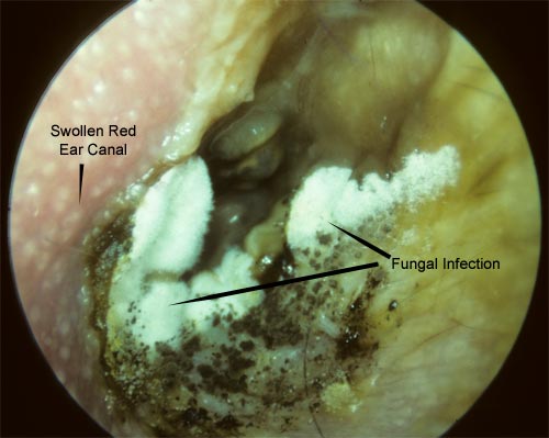 Swimmer's Ear Images  McGovern Medical School