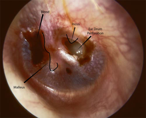 Seven year old nurse's son who perforated his ear drum using a Q Tip