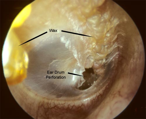 A healing perforated ear drum, a month after the injury.