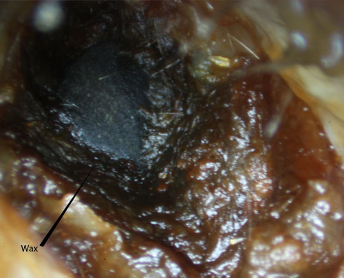 Adult with wax impaction and blocked hearing