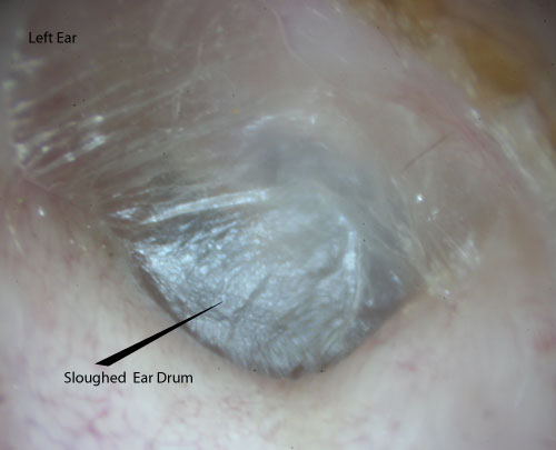 An adult seen several months after an ear infection