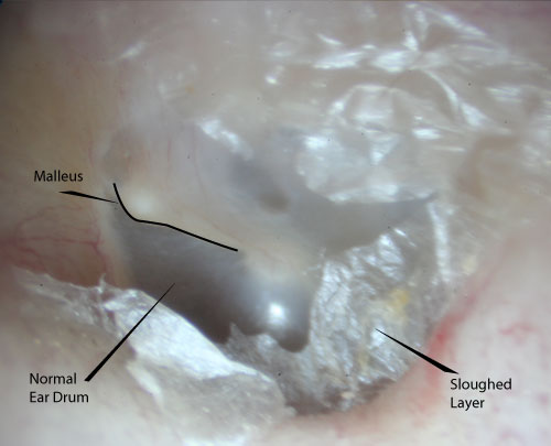 Normal looking ear drum once the sloughed layer was removed