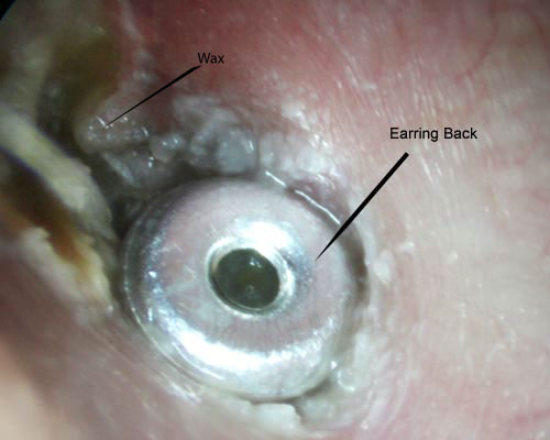 Ear ring back in ear canal with infection