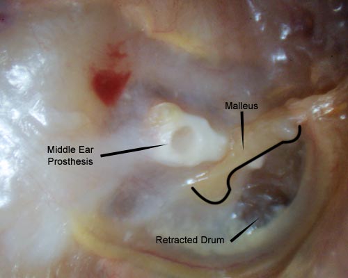 white prosthesis seen through the ear drum