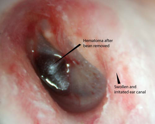 hematoma in ear