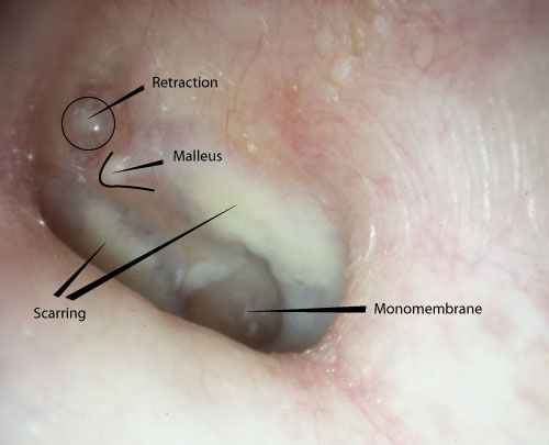 Trente ans avec une longue histoire de problèmes d'oreille