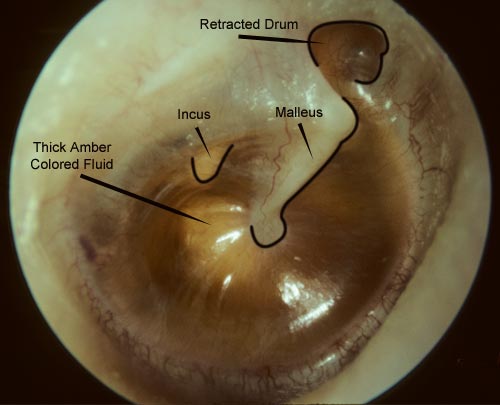 fluid in the middle ear