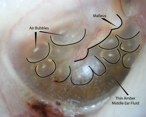 Adult with air bubbles in the middle ear