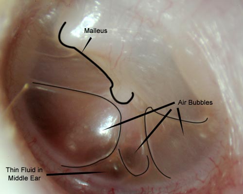 Teenager with air bubbles in the middle ear
