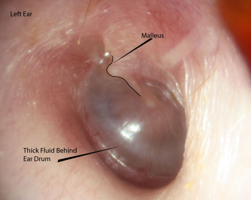 ear of adult that flew with nasal congestio