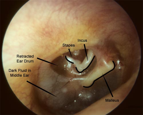 Twelve year old male with fluid in the middle ear