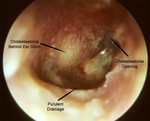 An adult with a draining ear from infection