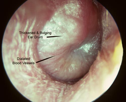 Adult with severe right ear pain and pressure with hearing loss