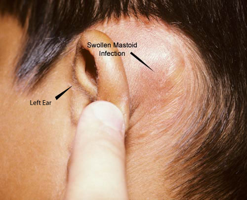 Eight year old boy with fever, severe ear pain and the outer ear being pushing forward by swelling behind the ear