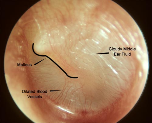Young person with a resolving ear infection