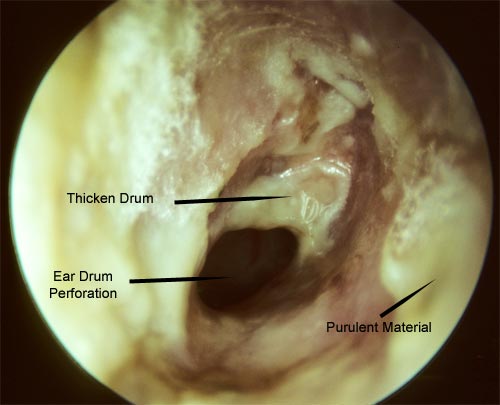 Seventy year old male with an infected draining ear for several years